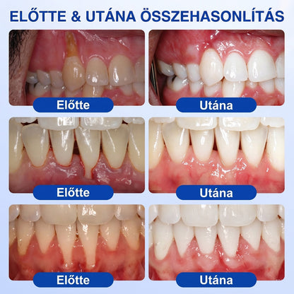 ⚪Dr.Era® GumRevive fogíny- és parodontális regeneráló gél — Célzott ápolás az ínyszélen lepedék, fogszuvasodás, fogágyproblémák, kellemetlen lehelet és meggyengült fogak esetén | Precízen alkalmazható, leöblítést nem igénylő szájápoló formula