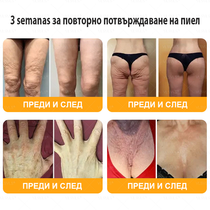 VLSVLS® ПЧЕЛНА ОТРОВА Комплексен крем - Последен ден 80% ОТСТЪПКА (Отпусната кожа, фини бръчки, загуба на стегнатост, плоски гърди, отпуснат ханш и още)🌴🌴