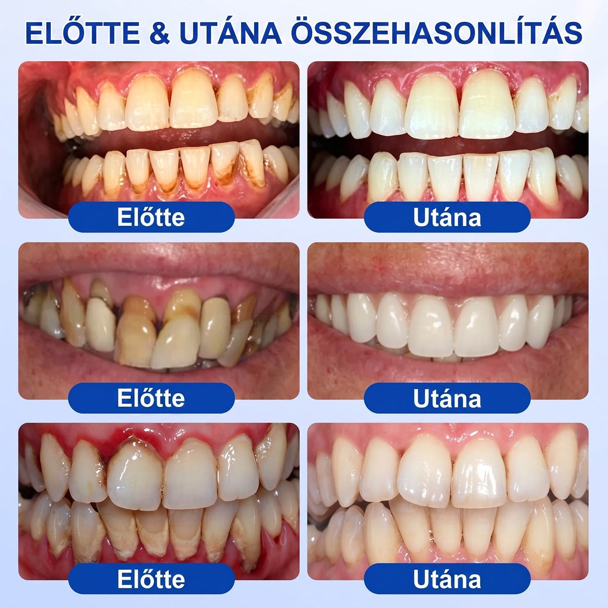 ⚪Dr.Era® GumRevive fogíny- és parodontális regeneráló gél — Célzott ápolás az ínyszélen lepedék, fogszuvasodás, fogágyproblémák, kellemetlen lehelet és meggyengült fogak esetén | Precízen alkalmazható, leöblítést nem igénylő szájápoló formula